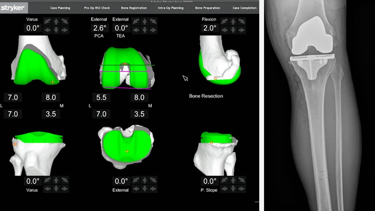 Robotic Total Knee Replacement CuttingEdge Surgery & Rapid Recovery